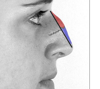 Muži pod skalpelem – plastika nosu