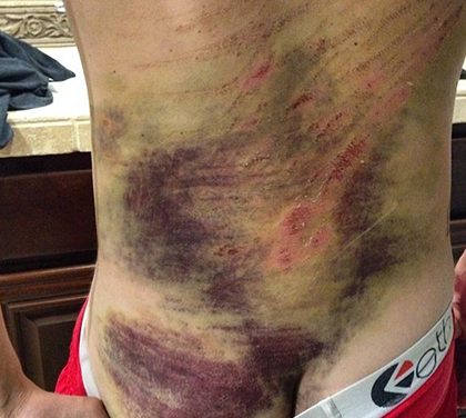 Sportem k trvalé invaliditě aneb top 5 nejhorších modřin ze sportu!