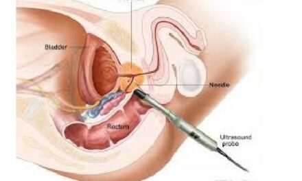 Fúzní biopsie prostaty umí zachytit nejčastější karcinom u mužů