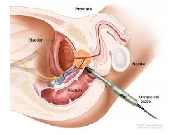 Fúzní biopsie prostaty umí zachytit nejčastější karcinom u mužů